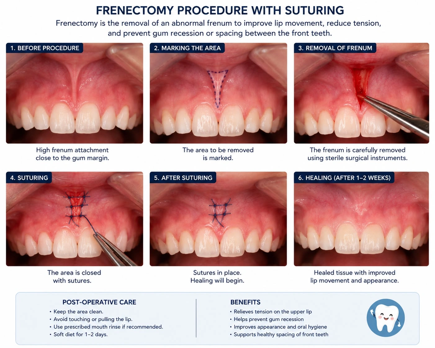 Six-step clinical chart showing a maxillary frenectomy procedure with suturing, featuring steps from initial marking and surgical removal of the high labial frenum tissue to the placement of stitches and the final healed gumline after one to two weeks.