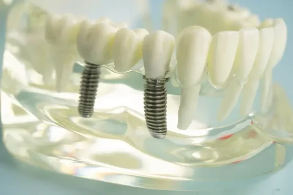 Transparent anatomical model illustrating multiple dental implants supporting a bridge restoration.