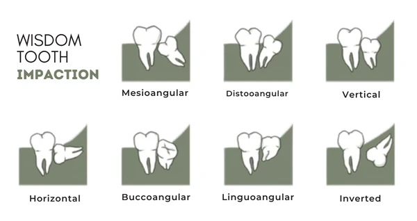 Types of wisdom tooth impaction diagram including mesioangular, distoangular, and horizontal classifications.