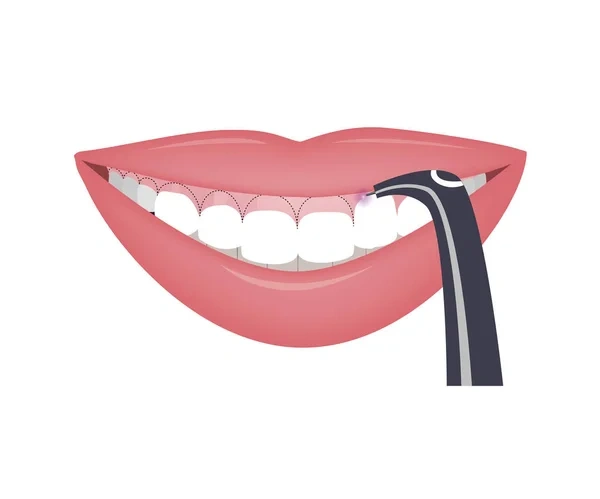 Vector illustration of a cosmetic dental laser reshaping a gummy smile to create a high, even smile line
